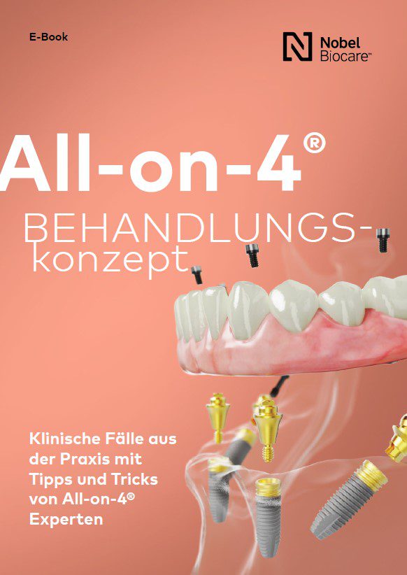 All-on-4 Behandlungskonzept (E-Book)